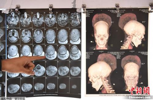 中国新闻网:印度男子脑部长1.87公斤巨瘤 手术7小时成功移除