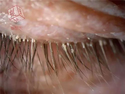 吓死宝宝了!睫毛里竟住着虫子,眼睛干痒的你一