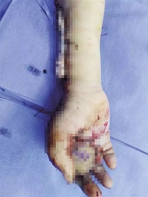 【提醒】突然，12岁男孩手指被炸飞！又是因为它这样爆炸→