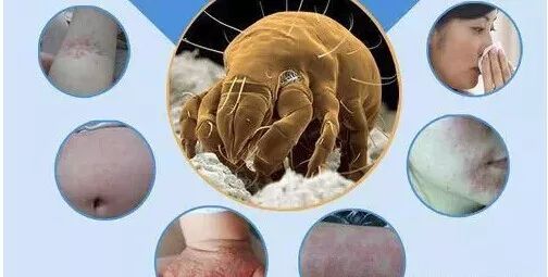 老人眼睫毛里长100多只虫子 常干这事的千万小