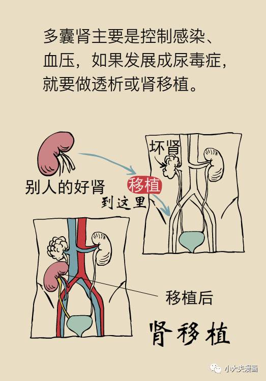 肾囊肿是个什么情况？北大教授来科普