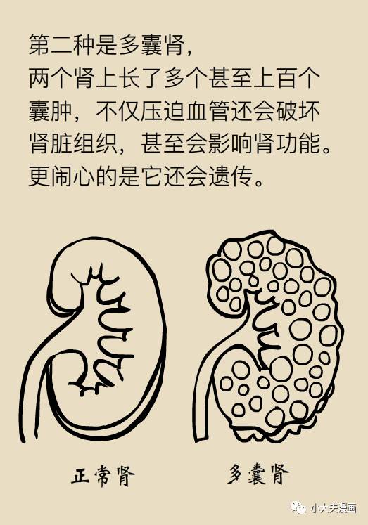 肾囊肿是个什么情况？北大教授来科普