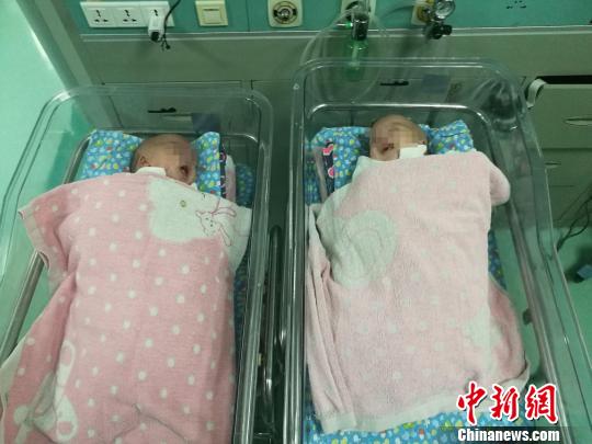 广西一对腹部连体男婴出生41天后成功分离(图)