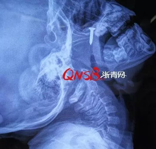 4岁男孩鼻子里掏出一颗螺丝钉