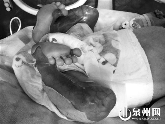 中国经济网:新生儿先天性皮肤缺失 双腿筋肉血管清晰可见(图)