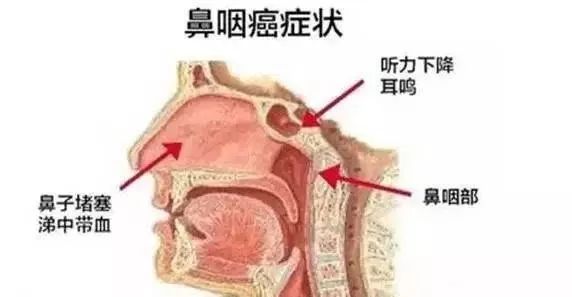 鼻癌的最明显症状_喉癌放疗需要多少钱