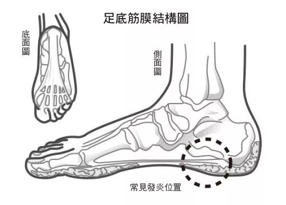小针刀治疗脚底筋膜炎是什么原理_小针刀治疗筋膜炎图解(3)
