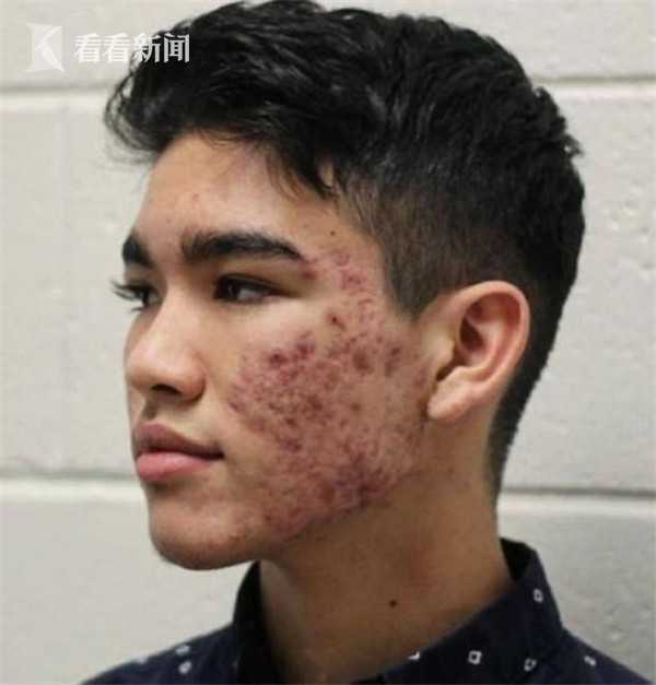 16岁男孩DIY护肤流程治好痤疮 每瓶花费不到2