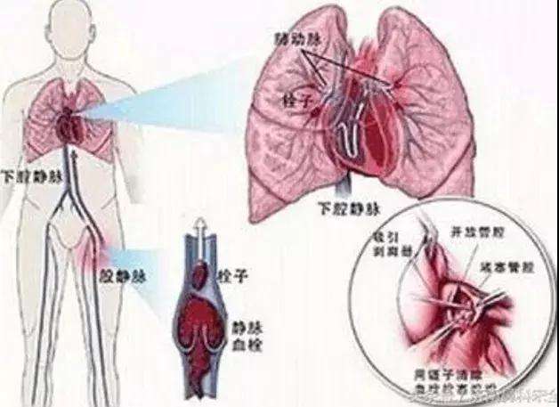 瓶里注脏水 致奶奶生命垂危|输液瓶|熊孩子|肺栓