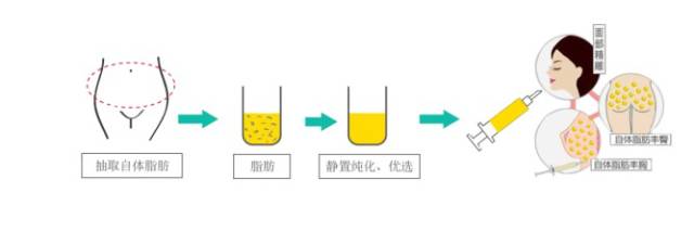 移植