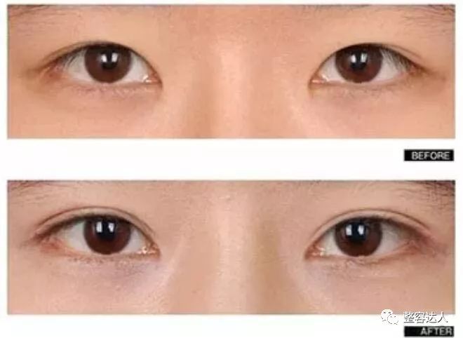 如何拥有三眼皮 kp6E-fyrcsrw6346148.jpg