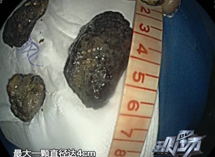 (戳链接看节目视频▼) 不看不知道,一看吓一跳 胃镜检查结果显示 吴
