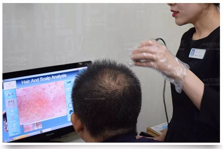 甚至秃顶!其实是它在作怪.|脱发|毛发移植|植发