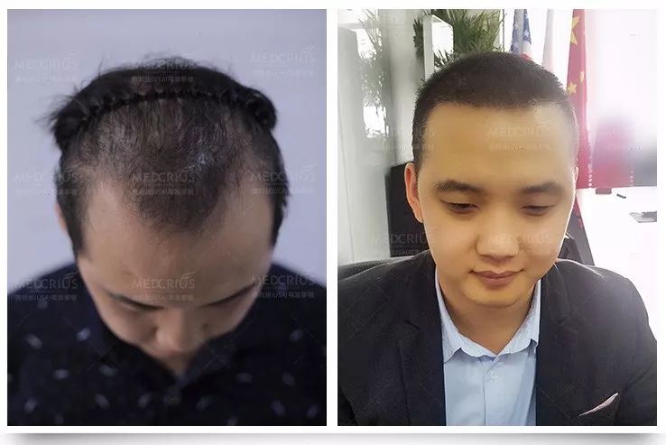 招募毛发缺失者，免费植发!脱发、秃顶、发际线高、眉毛稀缺……又可以免费治疗了!