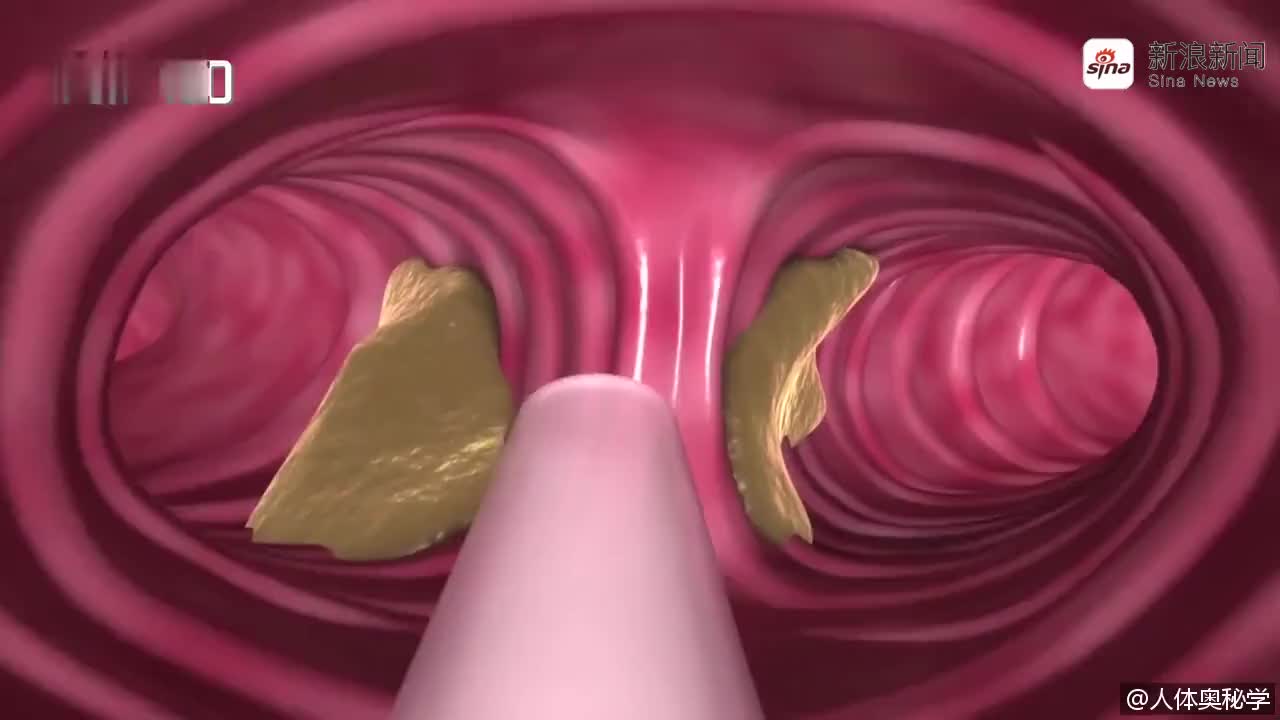 男性变性手术全过程,3d动画视频详细演示看完了你还想