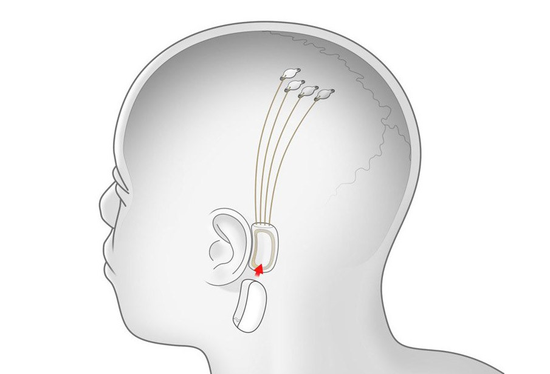 马斯克震撼发布脑机接口 Neuralink无损植入猪脑 下一步植入人脑