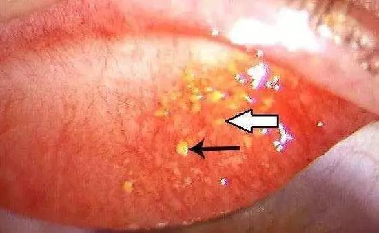 （圖為結膜結石，圖片來自作者）