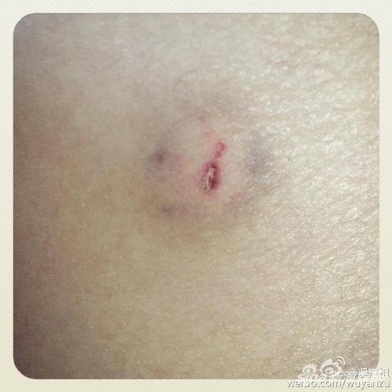 男神女兒牙口好!吳彥祖曬被女兒咬傷傷口