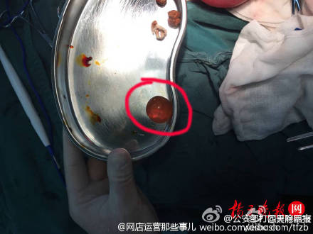 家长警惕!1岁男童误食“水宝宝” 致急性肠梗阻