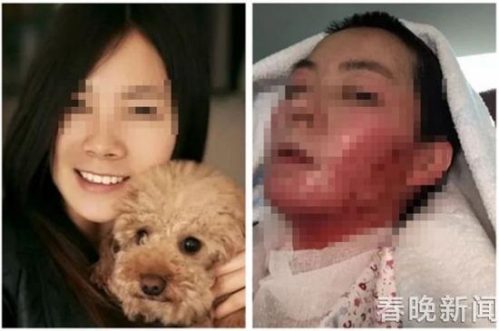 被烧伤前后对比照
