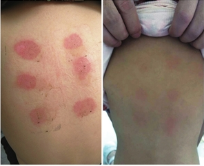 三伏贴后出现以上症状均属于正常现象