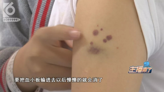 (灿灿因病情恶化,手臂上出现血小板过低的紫红色斑点,治疗相应增加输血次数,导致体内抗体过多,现在输一包血管三天。)