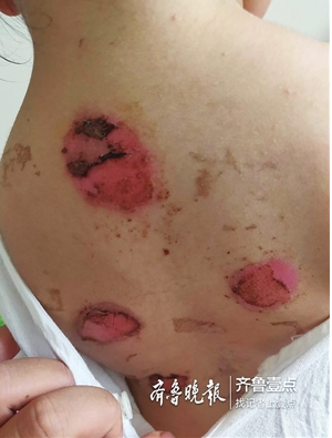 滕州多名儿童 贴了三伏贴后疑似被烫伤 齐鲁晚报记者 张冬梅 摄