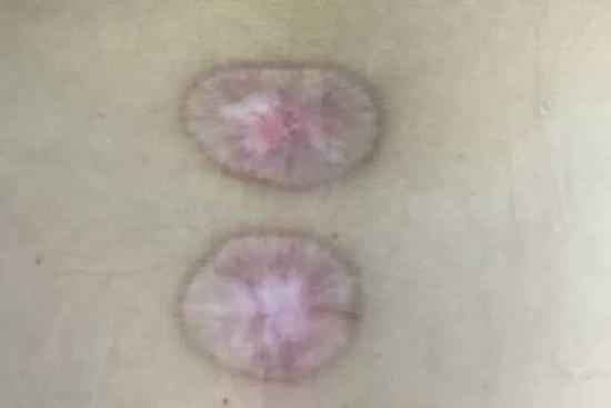 李阿姨腰背上的伤疤