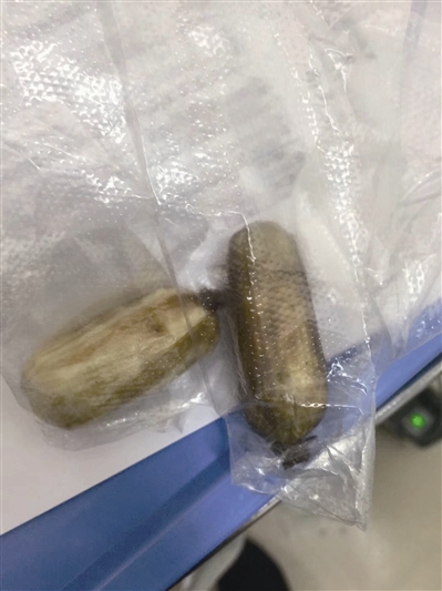 昨天医生从小伙子体内取出胶囊状异物 医院供图