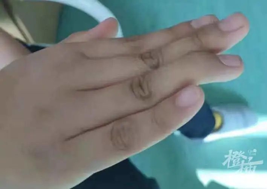 浙大儿院最近接诊好几例锤状指孩子 病因皆为打篮球