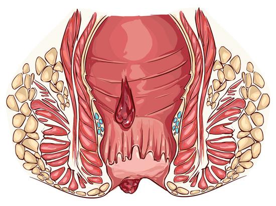 女痔疮外痔图片