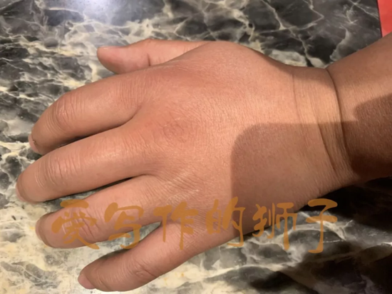 后来去医院一看,万幸没有伤到骨头,医生开了些药,爸爸就回家了。
