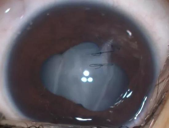(术前眼部照片)