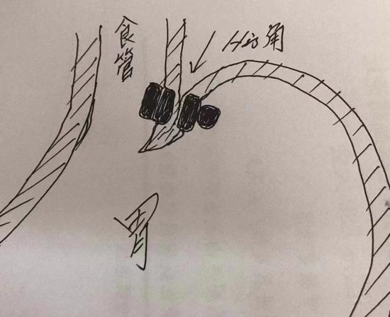 磁力珠所在位置示意图。His角即为食管与胃底间夹角