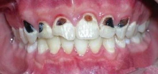 嘉兴1高中生爱喝碳酸饮料 拔掉8颗牙折断10颗