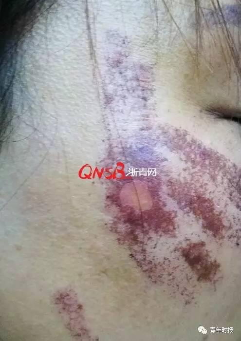 杭州39岁女子花3800元做光子嫩肤 美容不成却惨遭毁容