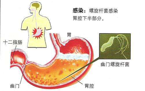 一言不合就揭秘:一款牙膏竟成幽门螺旋杆菌的"克星"_新浪浙江_新浪网