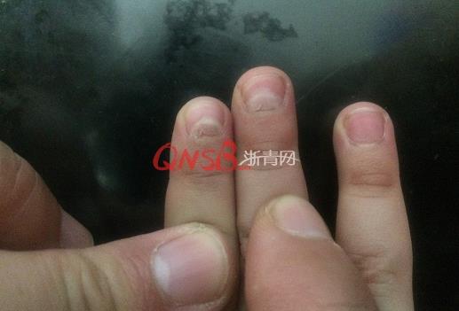 杭州4岁男孩手指甲突然间脱落 或因曾得过手足