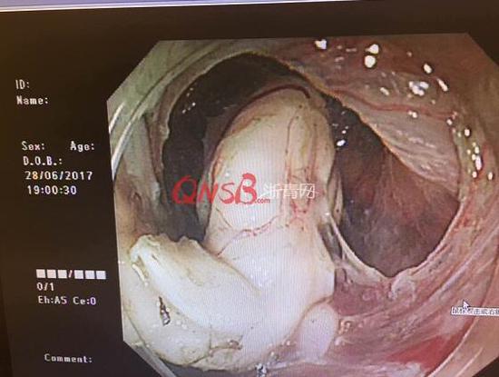 杭州女白领觉得喉咙有异物 医生从她嘴里拖出