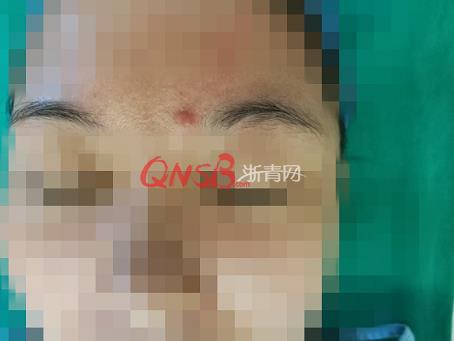 杭州女子脸部取出塑料子弹 曾被熊孩子击中离