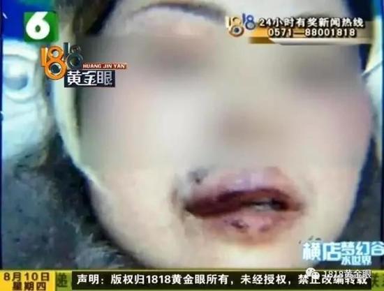 邵女士:“(每次打你是什么理由?)我不知道他为什么要打我(用什么东西打你?)拿了东西,比如皮带。”