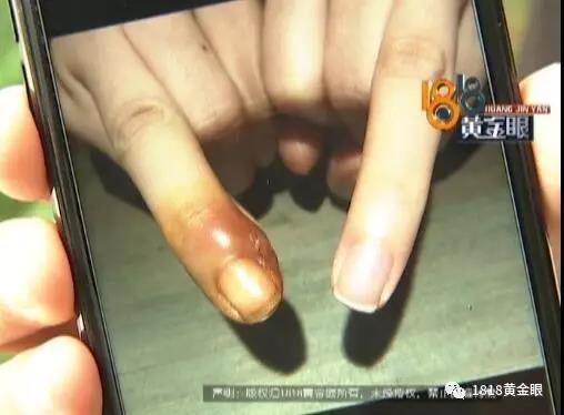 杭州1女生做美甲后手指红肿发炎 得甲沟炎痛得