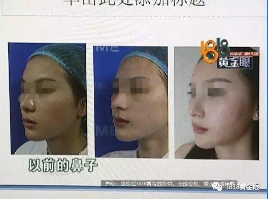 杭州1女子隆鼻之后鼻孔不对称:我以前鼻形蛮好