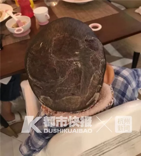 头部取皮植皮