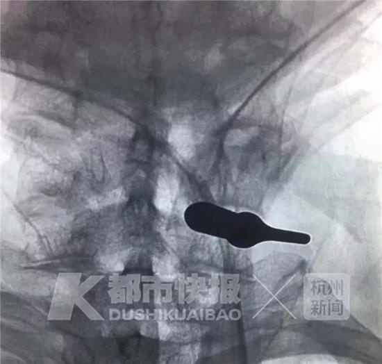 (小姚的颈椎片)