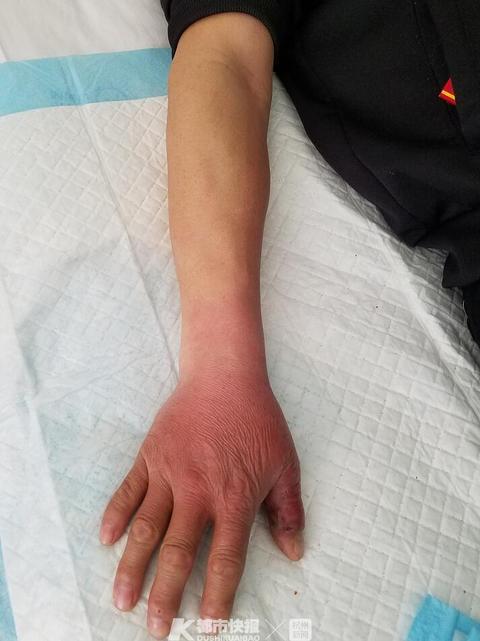 被咬的手 医院供图
