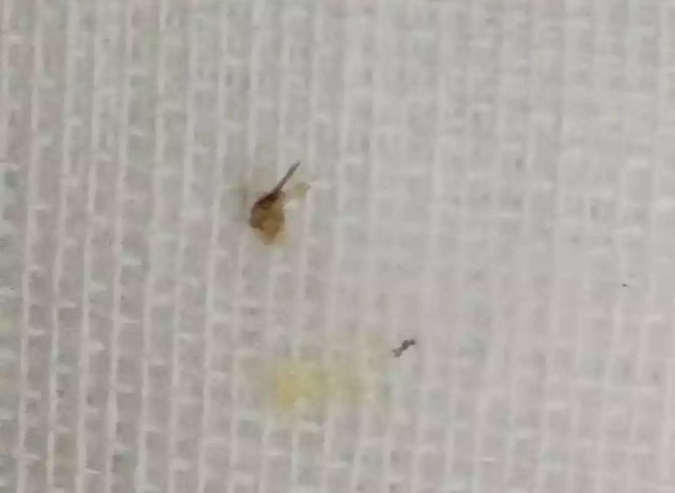 从小李喉部取出的蜜蜂毒针