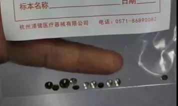 取出的颗粒 医院供图