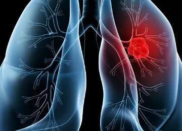 宁波女子剧烈头痛恶心干呕 一查发现是癌症晚