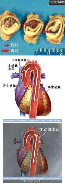 图为:主动脉夹层的病理图 浙江省人民医院供图